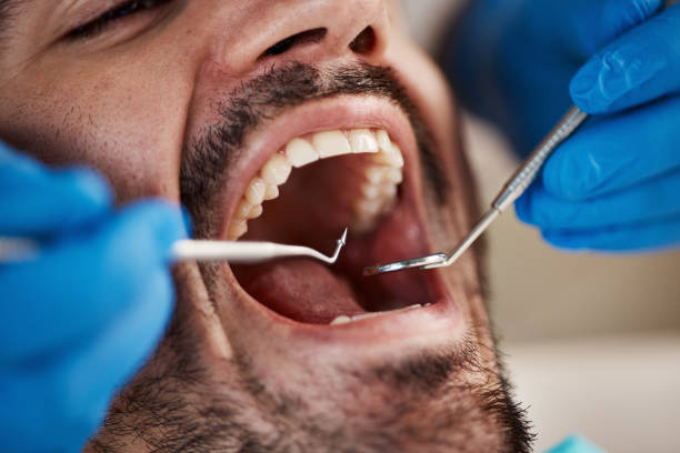 Best Emergency Wisdom Teeth Removal in Bevil Oaks, TX